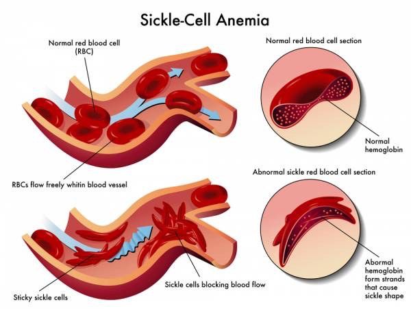 Sickle cell disease