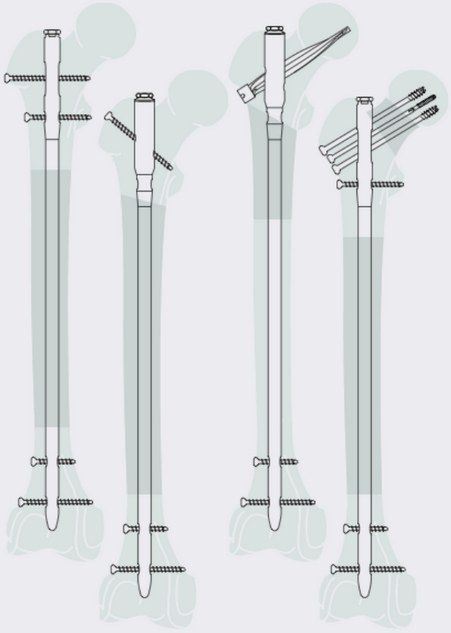Centromedullary nail