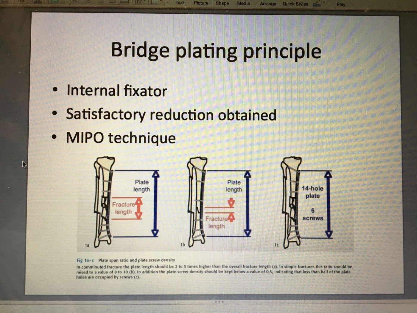 Ideal working length of a bridge plate = at least twice that of the fracture len