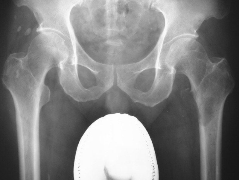 70/y Known Ca liver with bone met