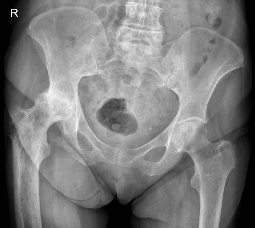 XR pelvis