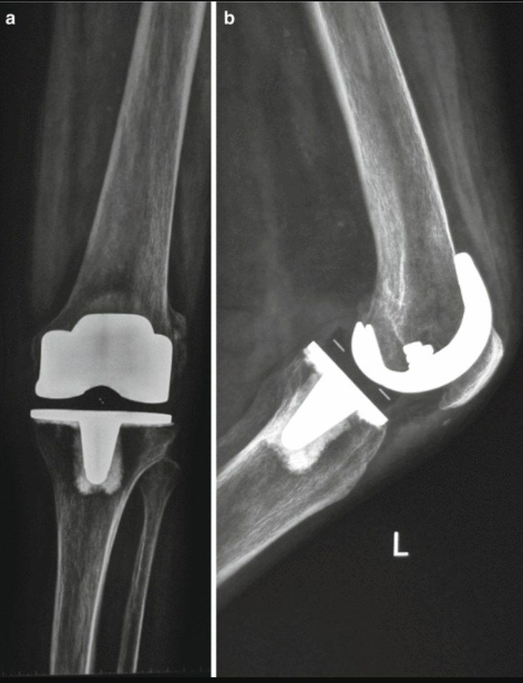 Principle: uncouple flexion/extension from axial rotation --> less stress on fix