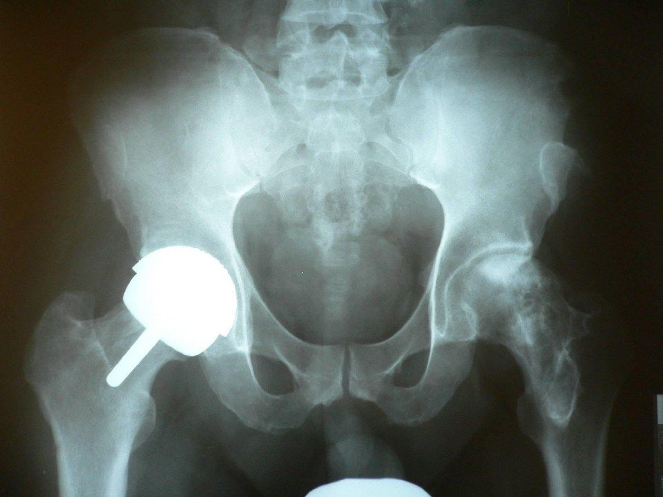 Hip resurfacing