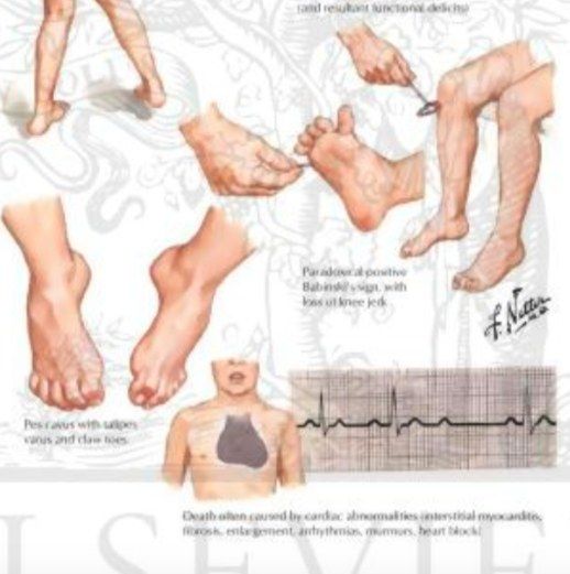 Friedreich's Ataxia