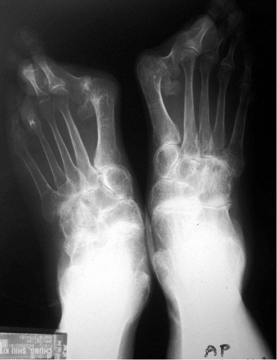 Xray bilateral foot showing severe hallux valgus deformity