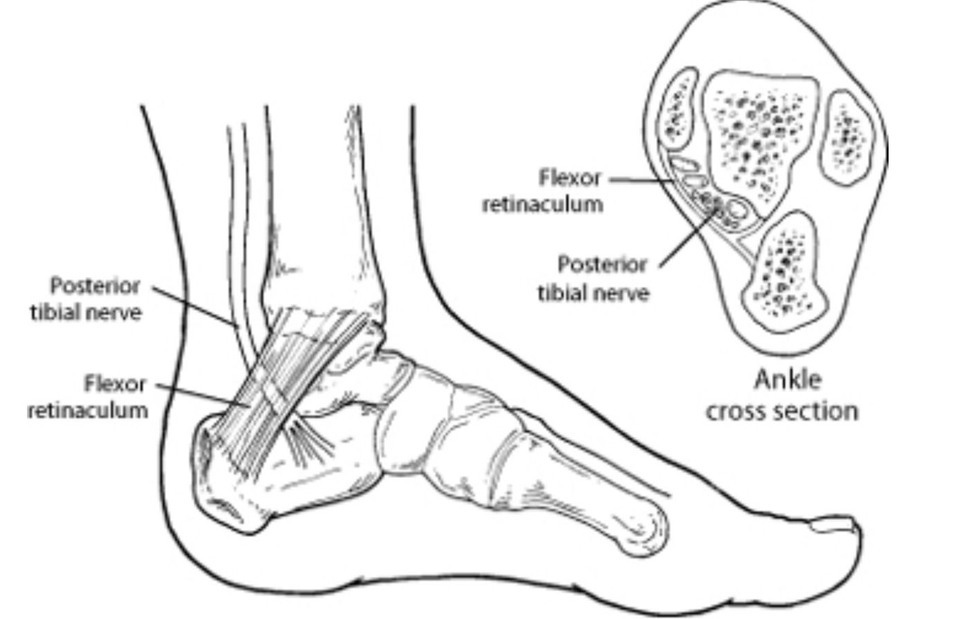 Tarsal tunnel syndrome