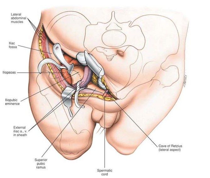 Ilioinguinal approach