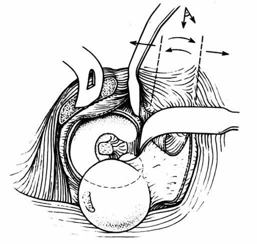 Fixation of femoral head with headless screws