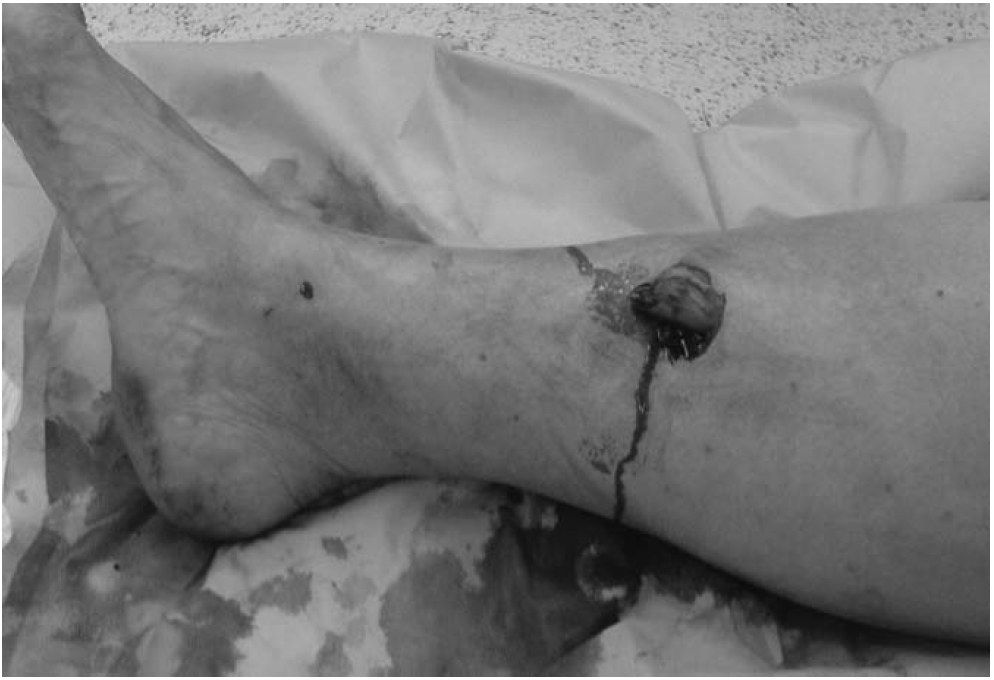 Gustilo I fracture tibial shaft with proximal fragment protruding out of skin in