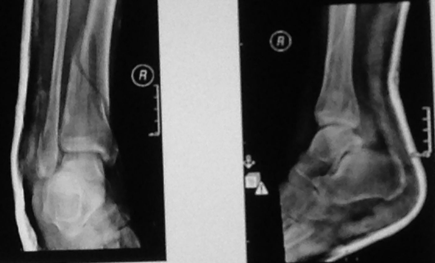 Distal 1/3 extraarticular tibia fracture