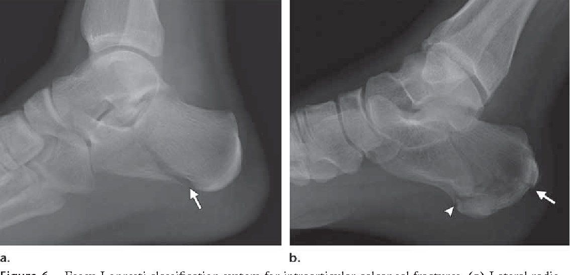 Lateral xray of the left ankle and foot showing fracture calcaneum