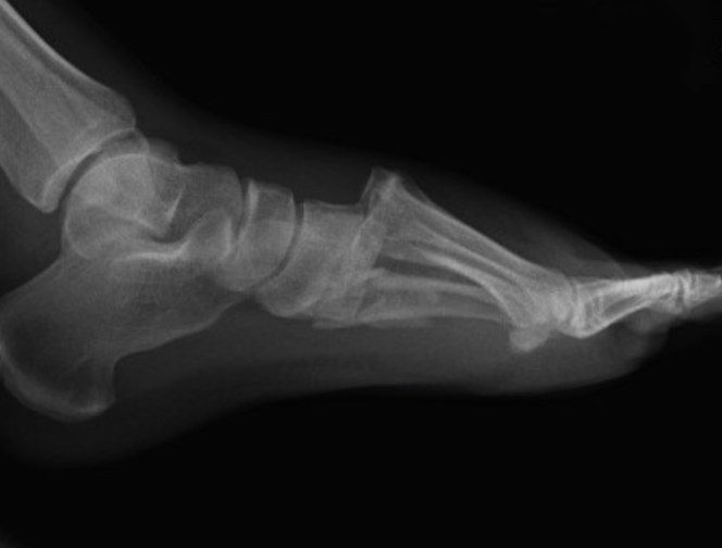 Xray