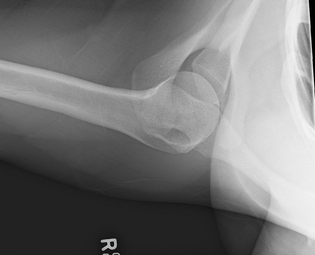 AP Xray showing ACJ dislocation with marked superior displacement of the distal