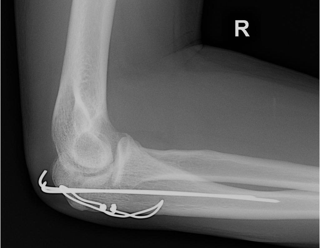 Olecranon fracture