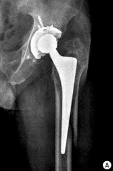 D1 post op