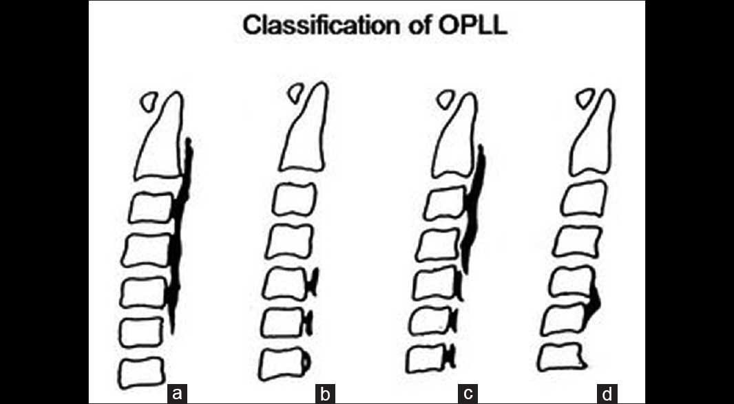 OPLL