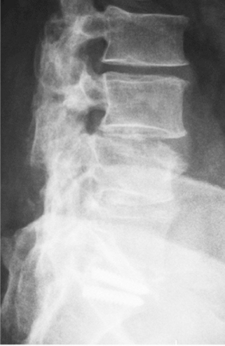 What is fail back syndrome?