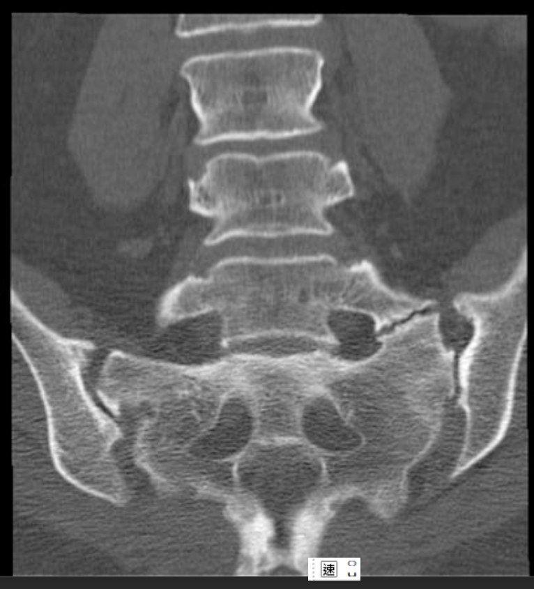 Bartolotti syndrome