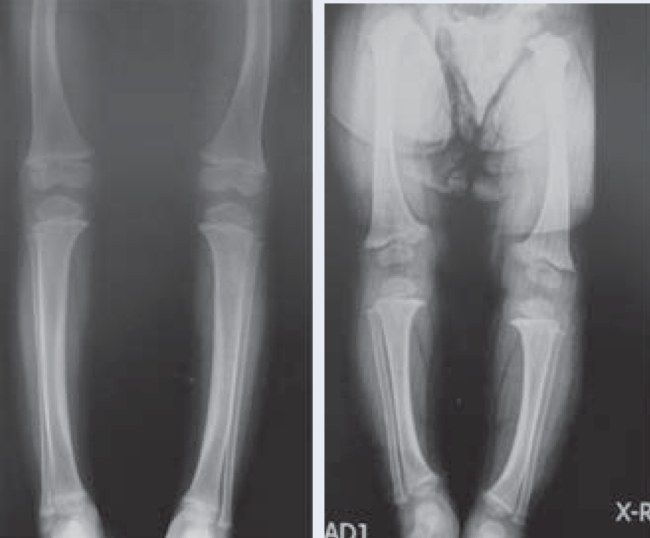Xray LL of skeletally immature patient