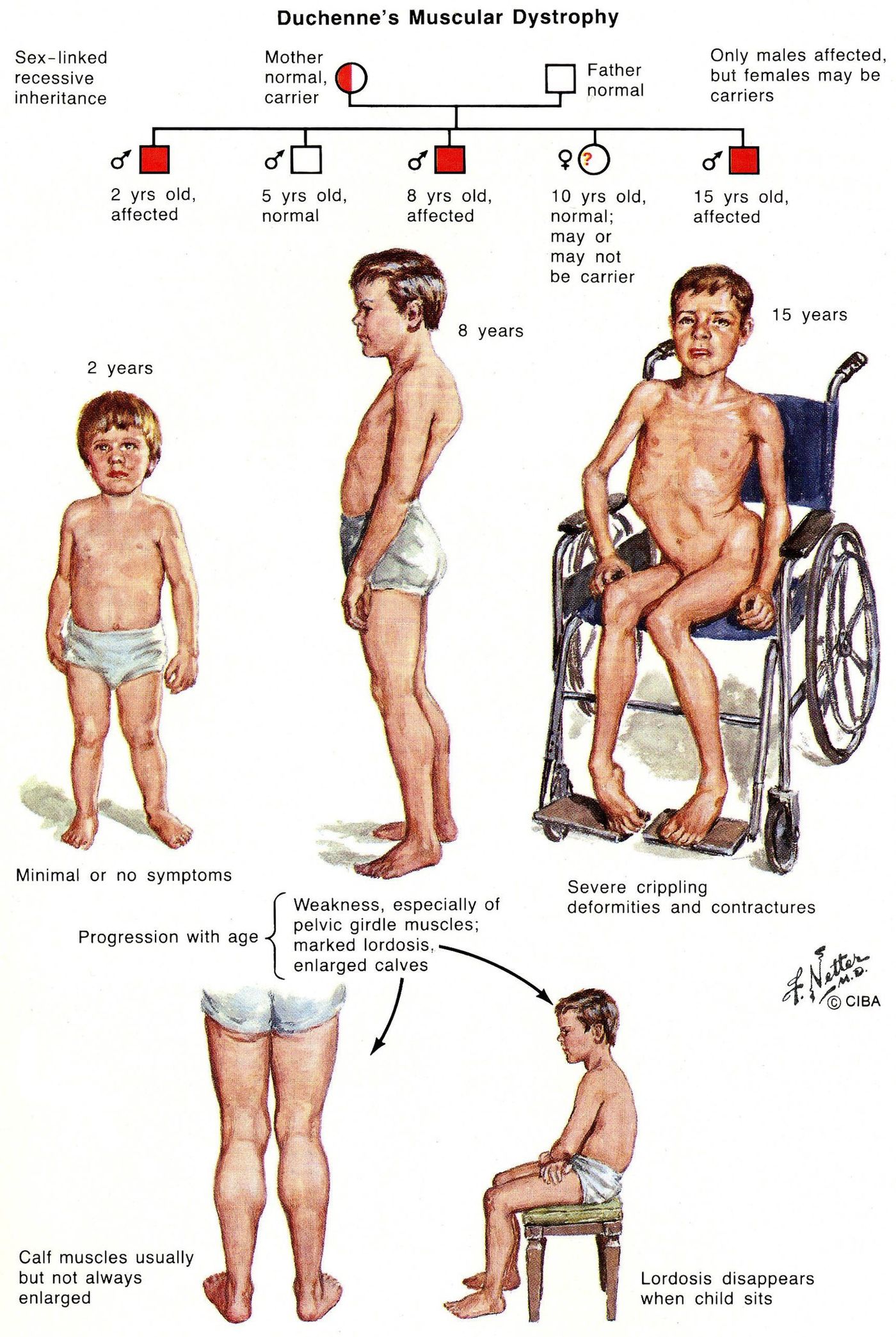 Duchenne muscular dystrophy