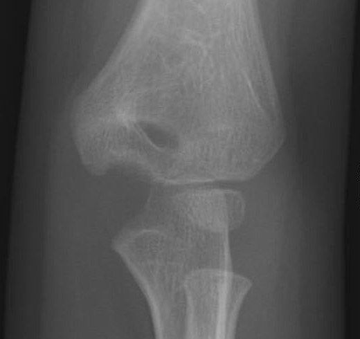Post lateral condyle fracture deformity