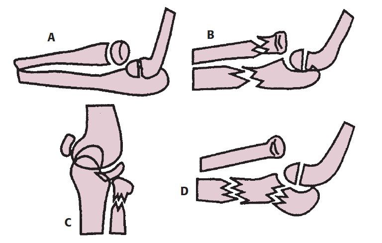 Acute and chronic px?