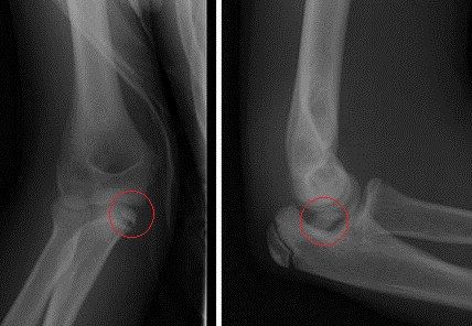 Fracture medial epicondyle with displacement of the fragment into the UHJ