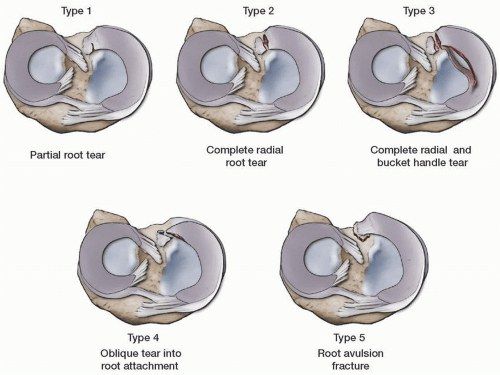 T2W MRI right knee