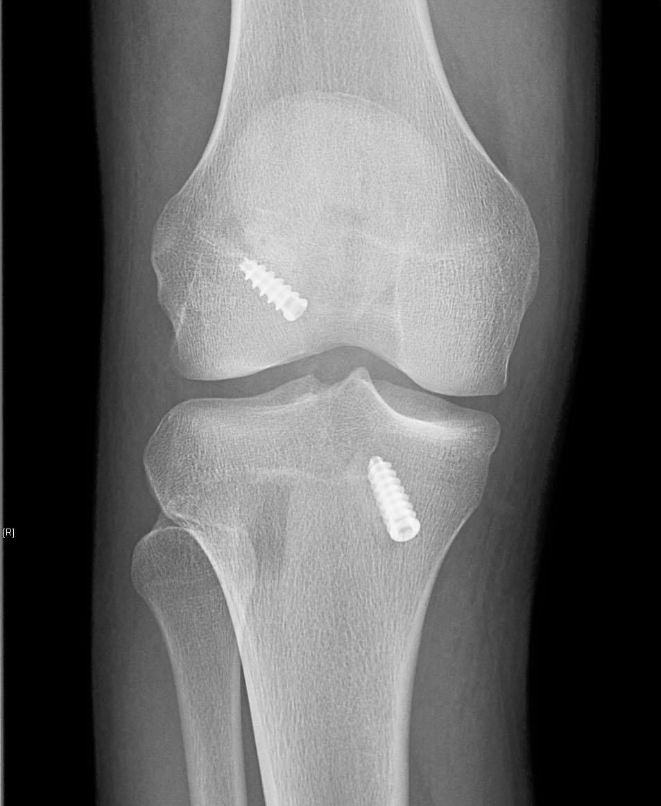 BPTB graft