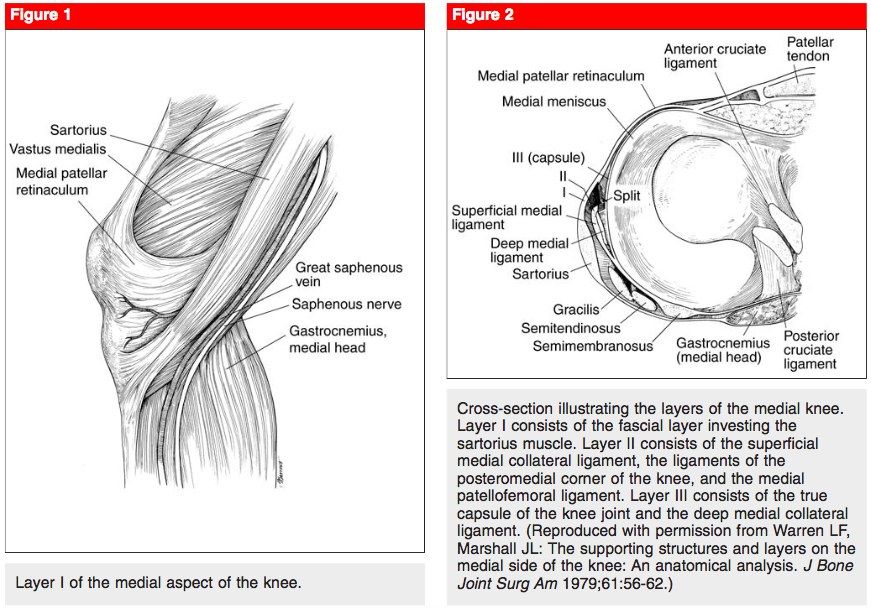 Stieda Pellegrini sign (few weeks after injury): ossified lesion signifying avul