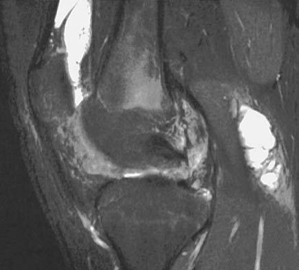 Middle age, M = F Recurrent atraumatic haemarthrosis