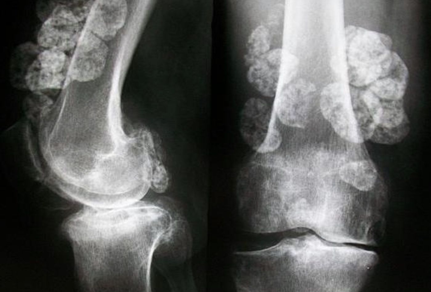 XR of the right proximal femur and right knee showing multiple well defined ossi