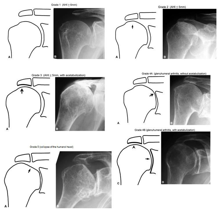 Rotator cuff arthropathy loss of force couple and fixed fulcrum