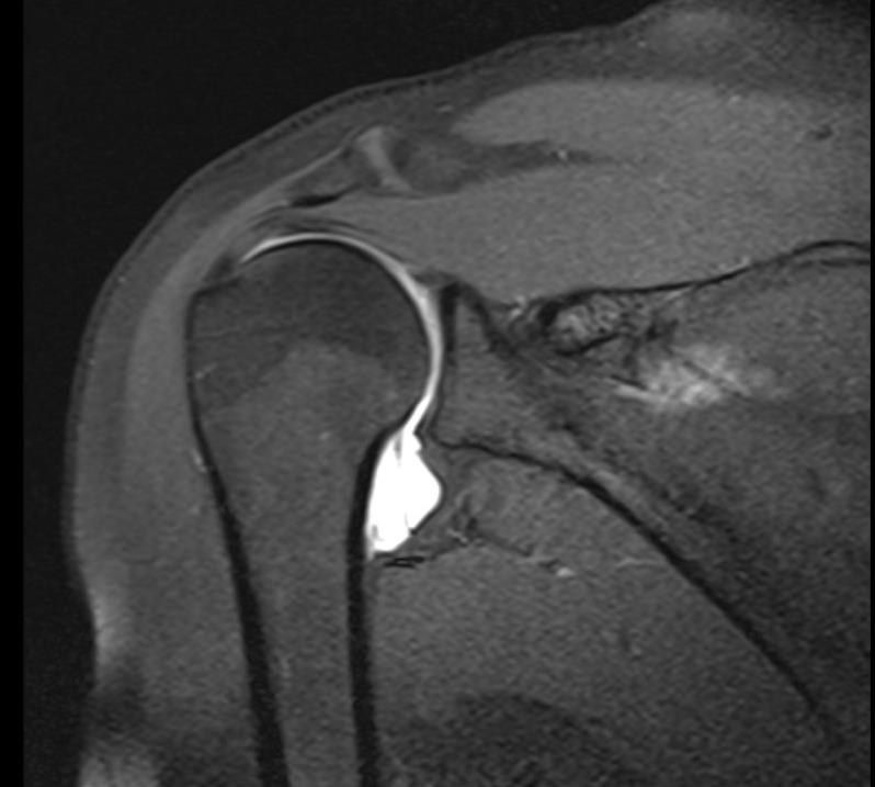 Humeral Avulsion of the Glenohumeral Ligament (HAGL)