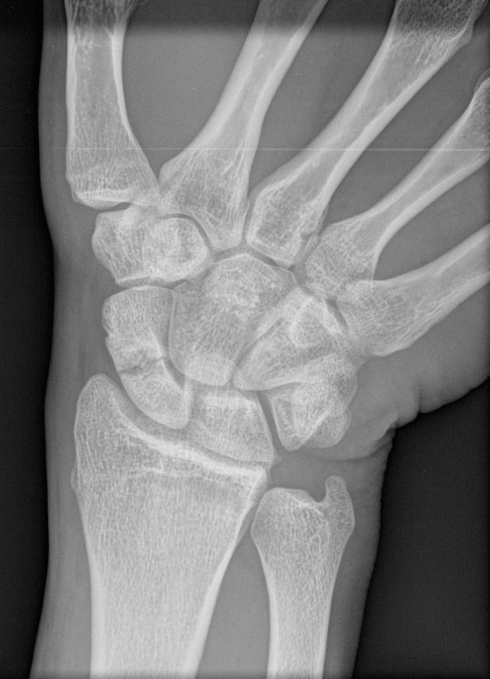 Scaphoid nonunion