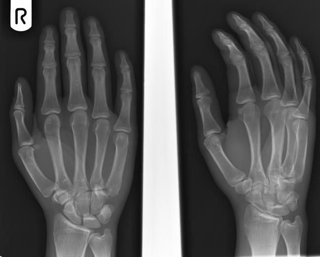 5th and 4th CMCJ dislocation