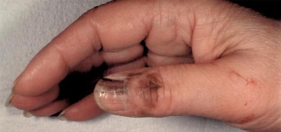 Melanoma