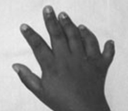 Post-axial polydactyly